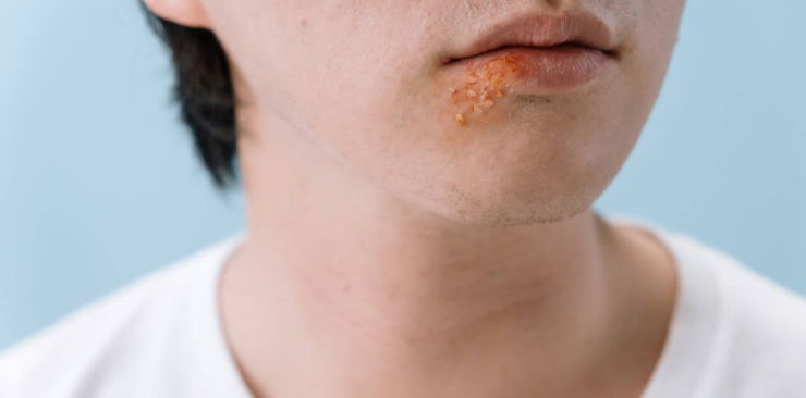Jak leczyć opryszczkę i szybko się jej pozbyć?
